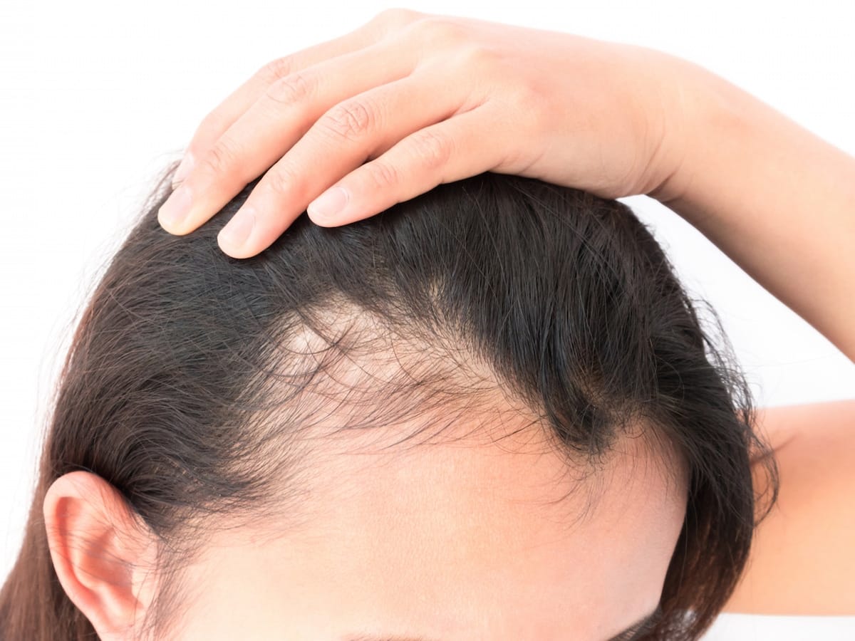 PRP (ПРП) - терапия в Хайфе и Крайот для здоровья волос ( טיפול פרפ )